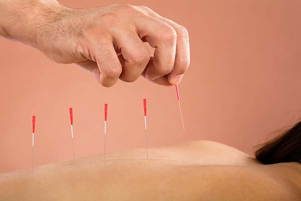 Acupuncture